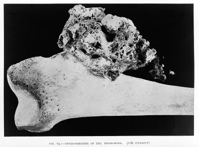 This 5th Dynasty thigh bone shows clear evidence of osteosarcoma, a form of bone cancer. A sobering reminder that serious disease was as muc