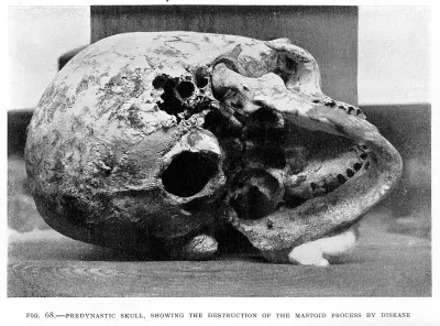 A Predynastic Egyptian skull showing evidence of disease affecting the mastoid process, the cone-shaped bone located behind the ear. Physica