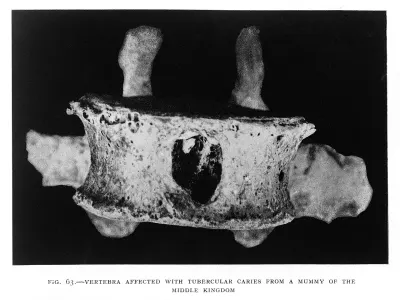 A Middle Kingdom mummy vertebra bearing the damage of tubercular caries, caused by tuberculosis attacking the spine. Evidence that one of hi